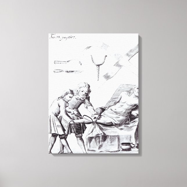 Kirurgiska ingrepp för att amputera ett ben canvastryck (Framsida)