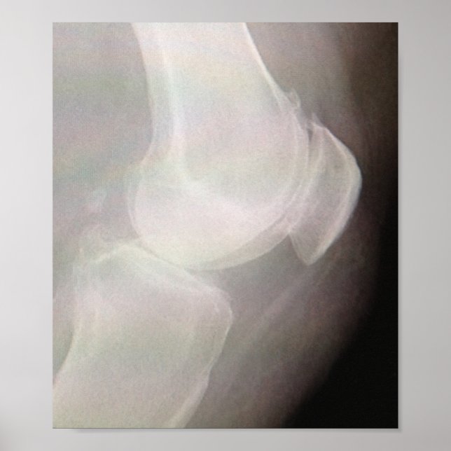 Knee X-ray Poster (Framsidan)