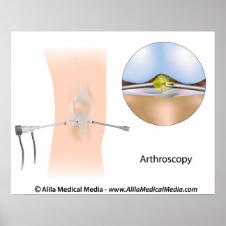 Kneets leddiagram. poster