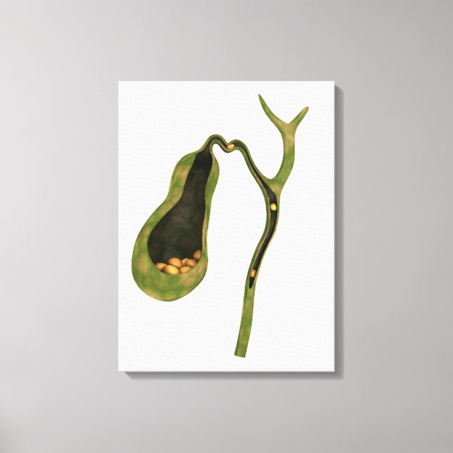 Konceptuell bild av gallsten inuti gallret (Framsida)