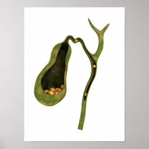 Konceptuell bild av gallsten inuti gallret poster