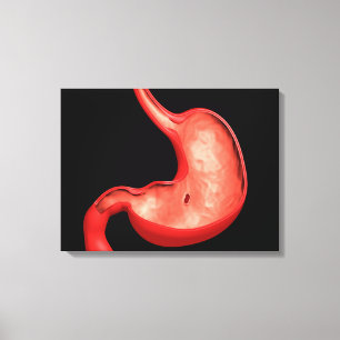 Konceptuell bild av Peptiskt ulcus i stomach