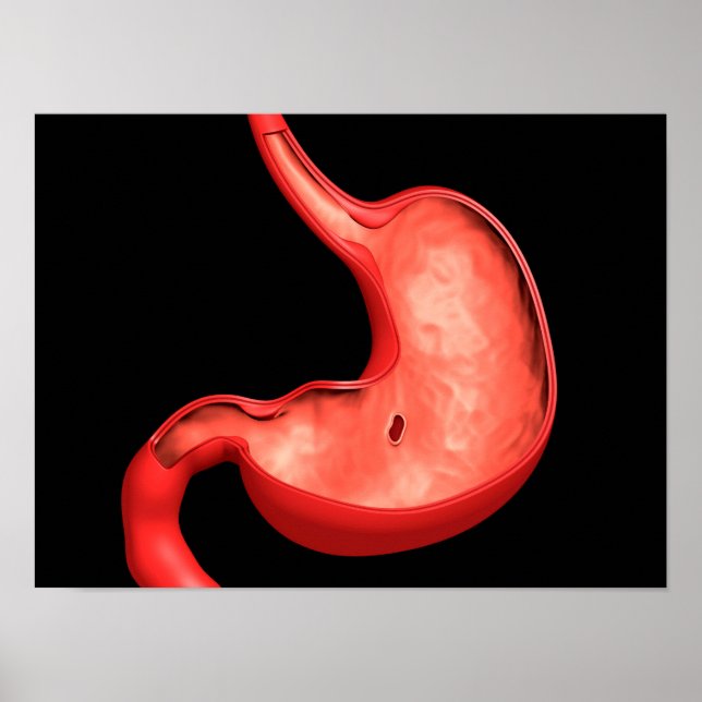 Konceptuell bild av Peptiskt ulcus i stomach Poster (Framsidan)