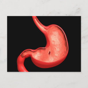 Konceptuell bild av Peptiskt ulcus i stomach Vykort