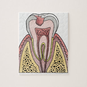 Kor-sektionens illustration som visar tand decay pussel
