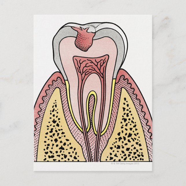 Kor-sektionens illustration som visar tand decay vykort (Framsida)
