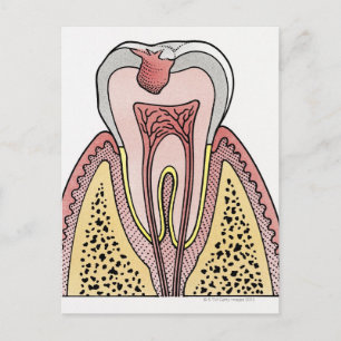 Kor-sektionens illustration som visar tand decay vykort