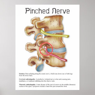 Kretchdiagram för nykapad nervös fysisk terapi poster