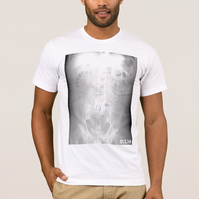 L-5/S1 CT Bildläsning-initialed-vid KLM Tee (Framsida)