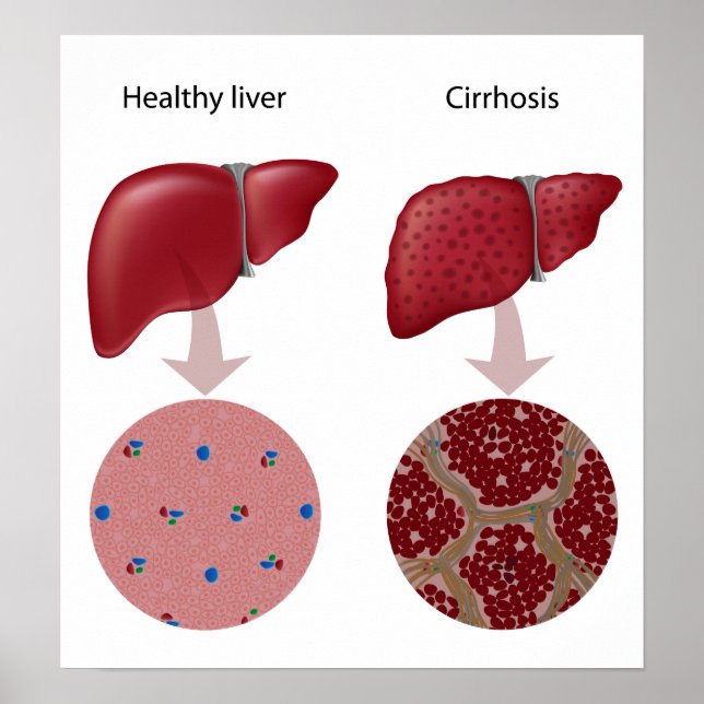 Leversjukdom Cirrhosis Poster (Framsidan)