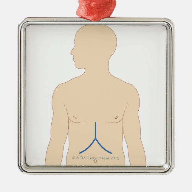 Levertransplantat Julgransprydnad Metall (Framsidan)