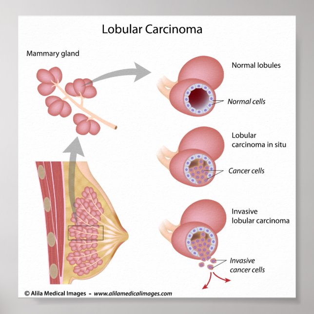 Lobulär bröstcancer, märkt diagram. poster (Framsidan)