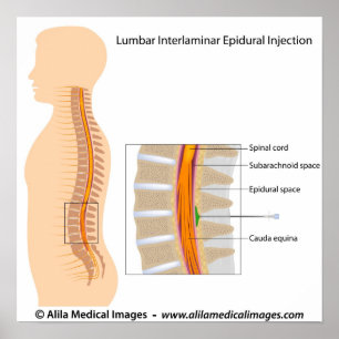 Lumbalepidural injektion, märkt diagram. poster