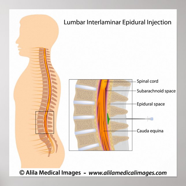 Lumbalepidural injektion, märkt diagram. poster (Framsidan)
