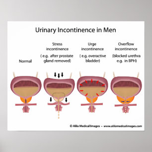 Manlig urininkontinens poster
