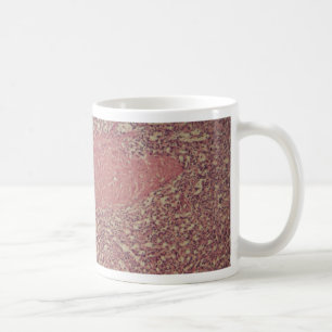 Människaspleen med kronisk myelogenous leukemia kaffemugg