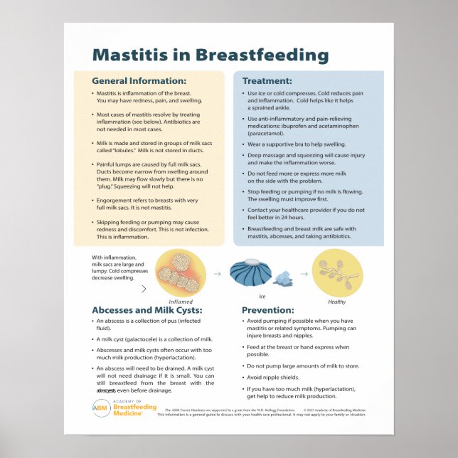 Mastit i amning Poster (engelska) (Framsidan)