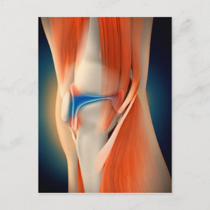 Medicinsk illustration: Inflammation i knä Vykort