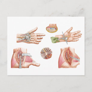 Medicinsk illustration som visar karpaltunneln vykort