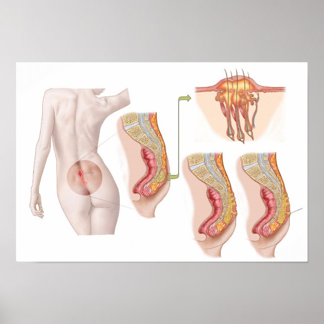 Medicinsk indikation på en pilonidal cysta poster (Framsidan)