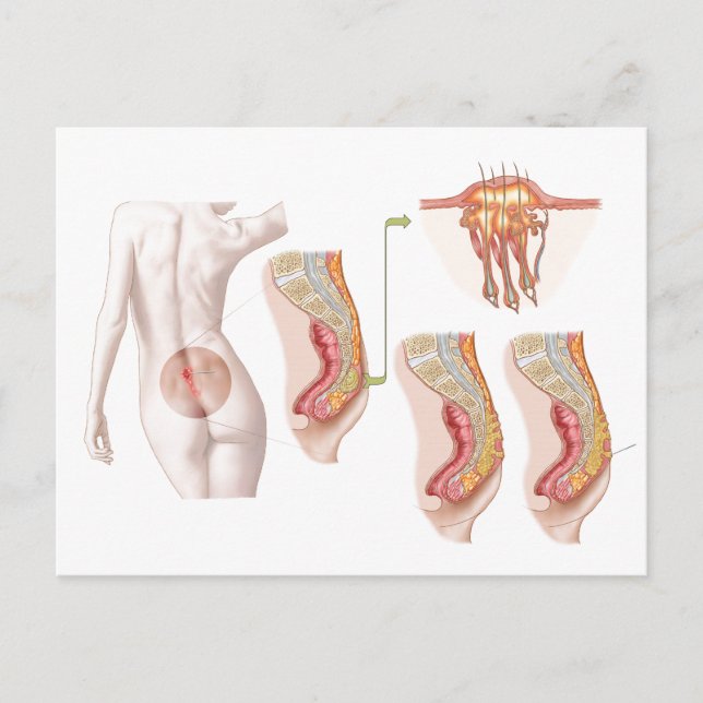 Medicinsk indikation på en pilonidal cysta vykort (Framsida)