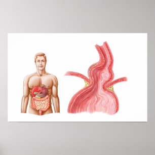 Medicinsk indikation på ett hiatalt kärlkramp i poster