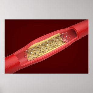 Medicinsk stent inne i blodkärl poster