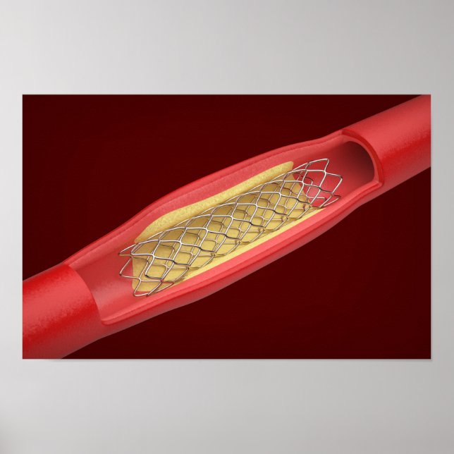 Medicinsk stent inne i blodkärl poster (Framsidan)