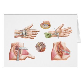 Medicinsk tunnel för illustrationvisningCarpal Hälsningskort