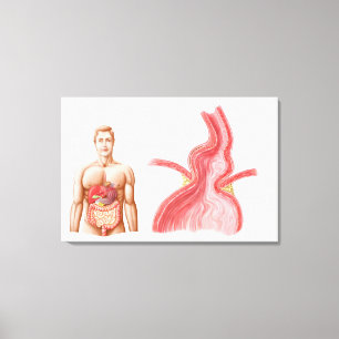 Medicinska Ilustration av en Hiatal bråck i Canvastryck