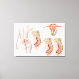 Medicinska Ilustration av en Pilonidal cysta Canvastryck