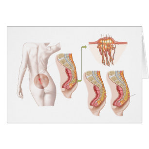 Medicinska Ilustration av en Pilonidal cysta Hälsningskort