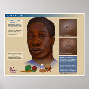 Melalogic Acne och Diet Medical Poster
