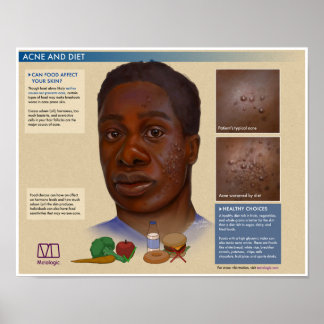 Melalogic Acne och Diet Medical Poster