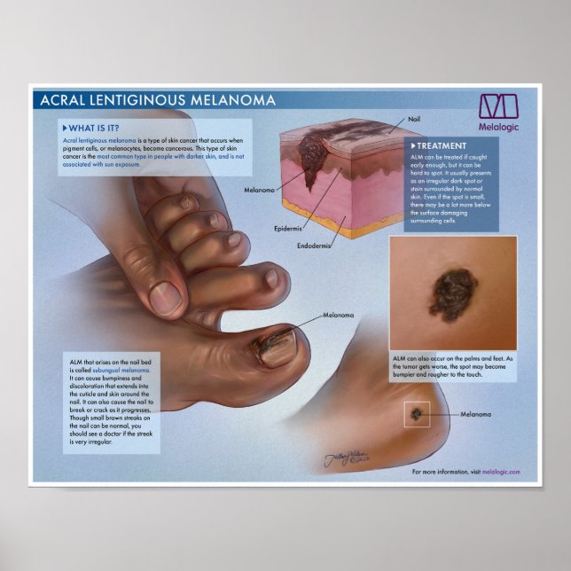 Melalogic Acral Lentiginous Melanoma Medical Poste Poster (Framsidan)