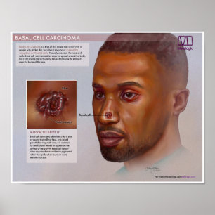 Melalogic Basal Cell Carcinoma LäkarPoster Poster