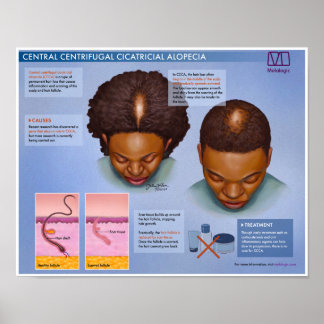 Melalogic Central Centrifugal Cicatricial Alopecia Poster