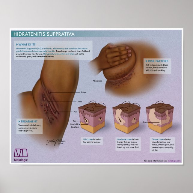 Melalogic Hidradenitis Supprativa Medical Poster (Framsidan)
