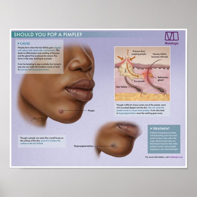 Melalogic Popping Pimples Medical Poster (Framsidan)