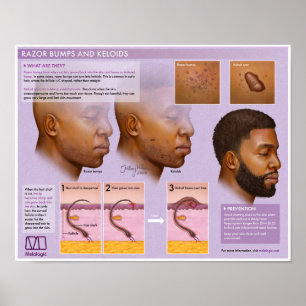 Melalogic Razor Bumps och Keloids Medical Poster