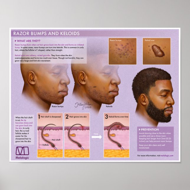 Melalogic Razor Bumps och Keloids Medical Poster (Framsidan)