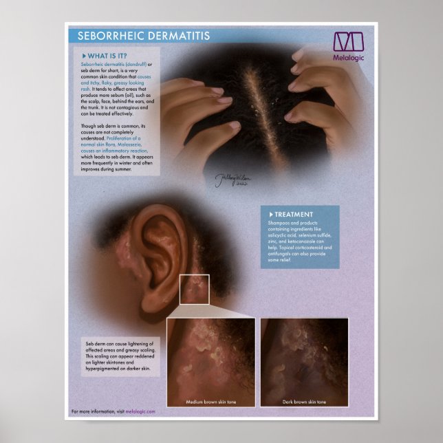Melalogic Seborrheic Dermatitis (Dandruff) Medical Poster (Framsidan)