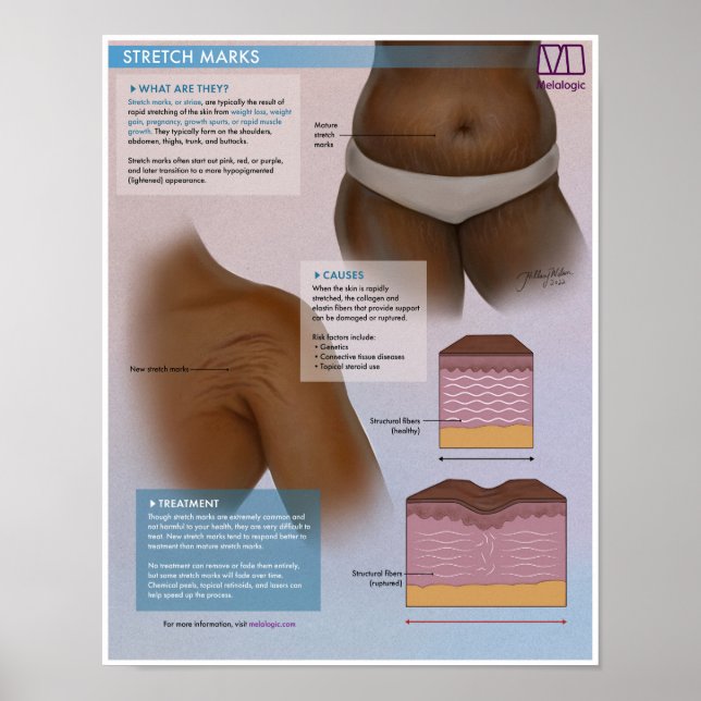 Melalogic Stretch Marks Medical Poster (Framsidan)