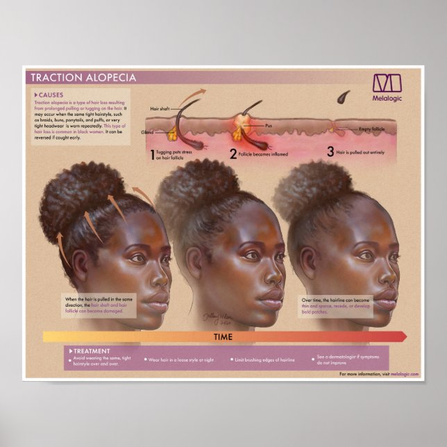 Melalogic Traction Alopecia Medical Poster (Framsidan)