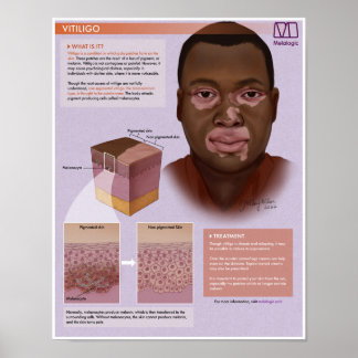 Melalogic Vitiligo Medical Poster