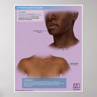 Melalogisk hyperpigmentering Medicinsk Poster