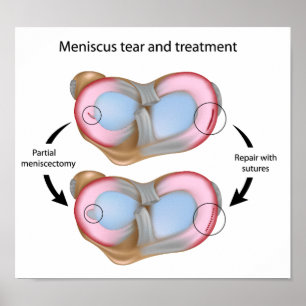 Meniscus tårar och kirurgi Poster