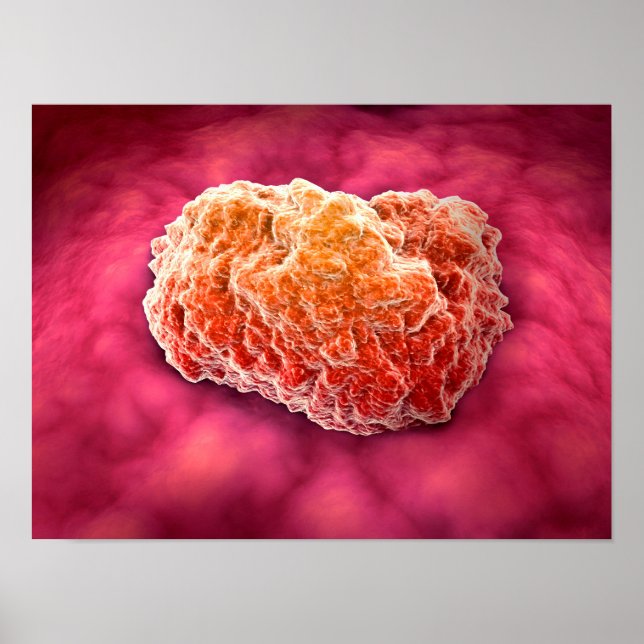 Mikroskopisk vy av tumor 3 poster (Framsidan)