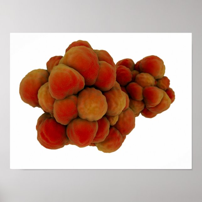 Mikroskopisk vy av tumör 4 poster (Framsidan)