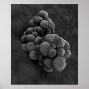 Mikroskopiskt beskåda av Tumor 1 Poster